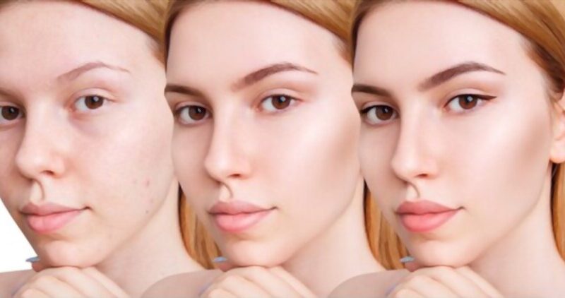 ¿Como cubrir el acné con maquillaje?